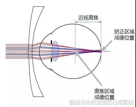 做眼睛近视手术的原理_做近视手术前必须要做眼部检查,医生根据检查的结果,评估你是否适合