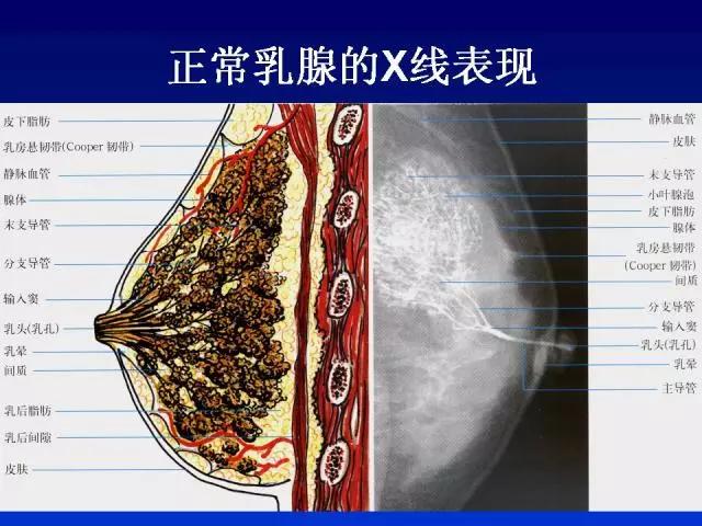 某个分岔处,长时间不能顺利排出时,局部乳腺管就会被乳汁撑得硬邦邦的