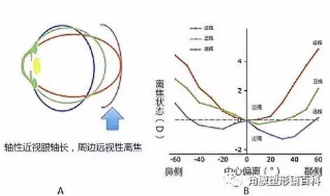 塑形镜的原理_△角膜塑形镜视力矫正原理