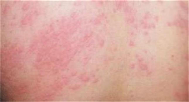 【秋季荨麻疹】秋季荨麻疹如何治疗_秋季荨麻疹的原因是什么