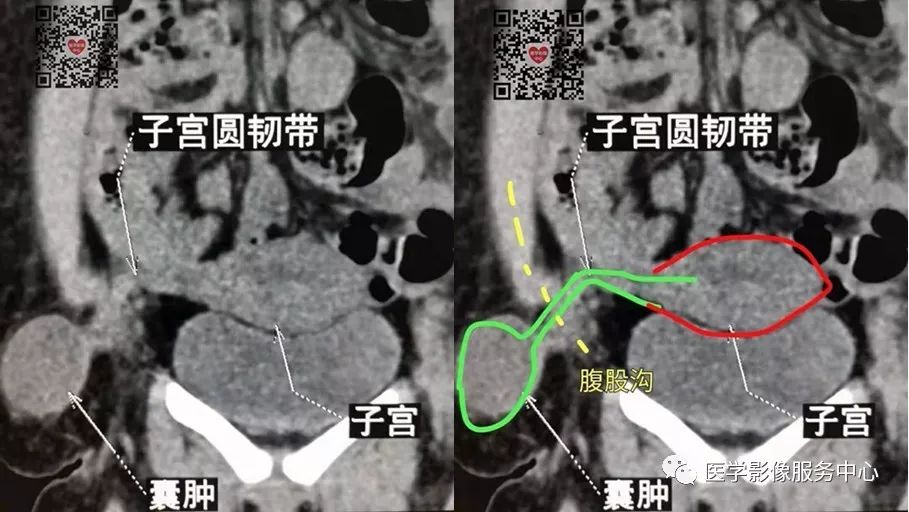 从解剖上子宫圆韧带起源于子宫双角,向前下方伸展达两侧盆腔,穿过腹股