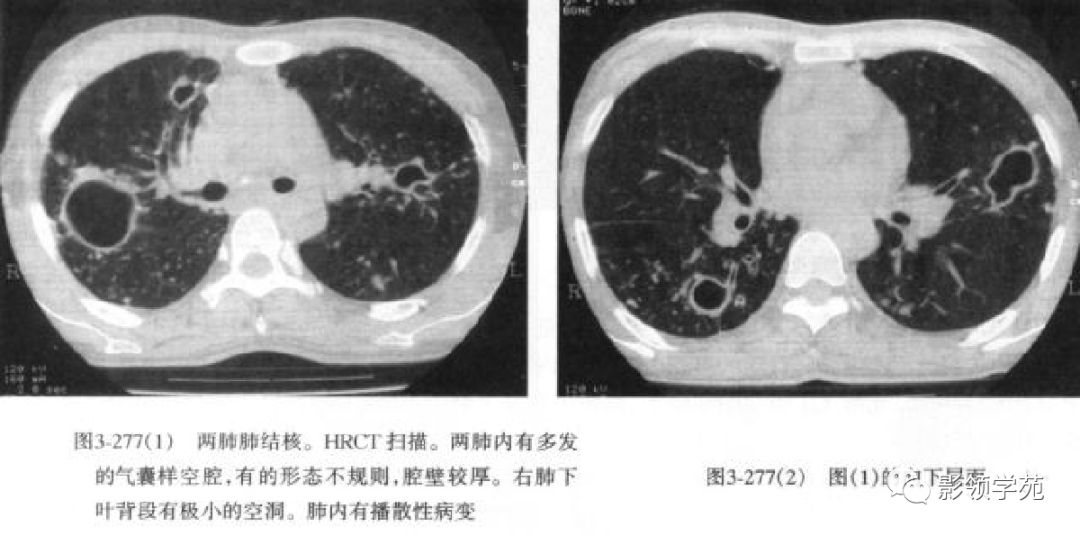 多发性结核空洞 2.肺转移瘤