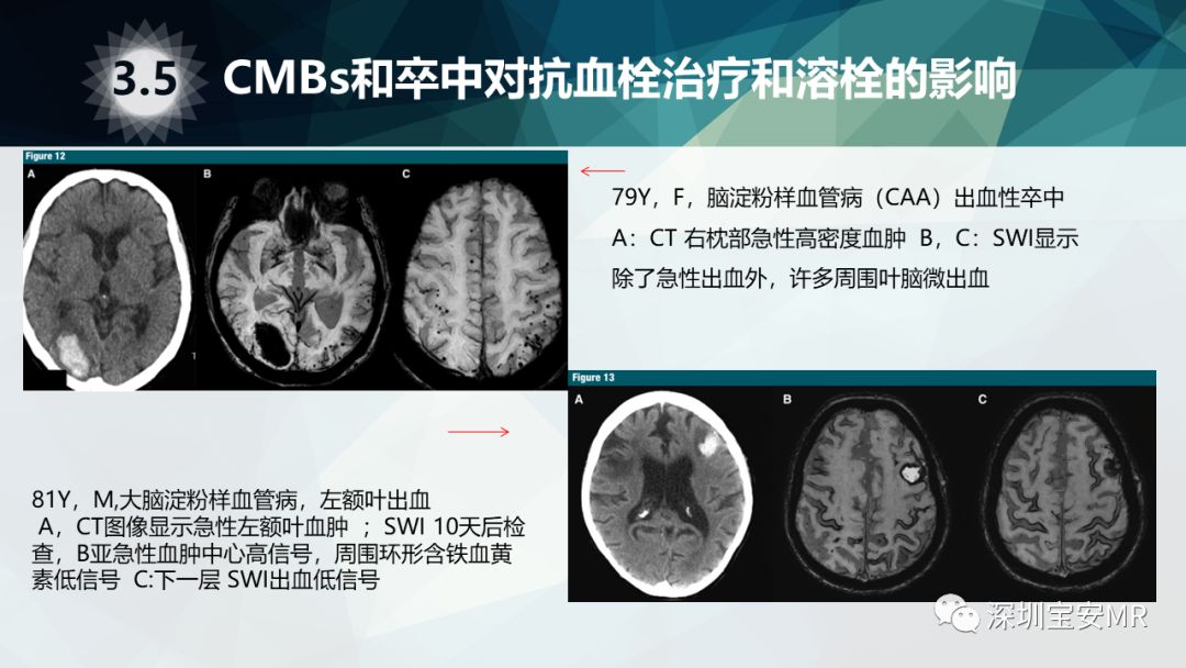 脑微出血:影像学和临床意义