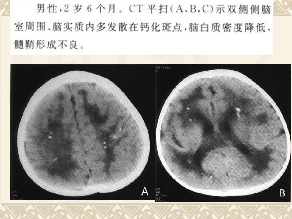 颅内钙化ctmri诊断鉴别诊断