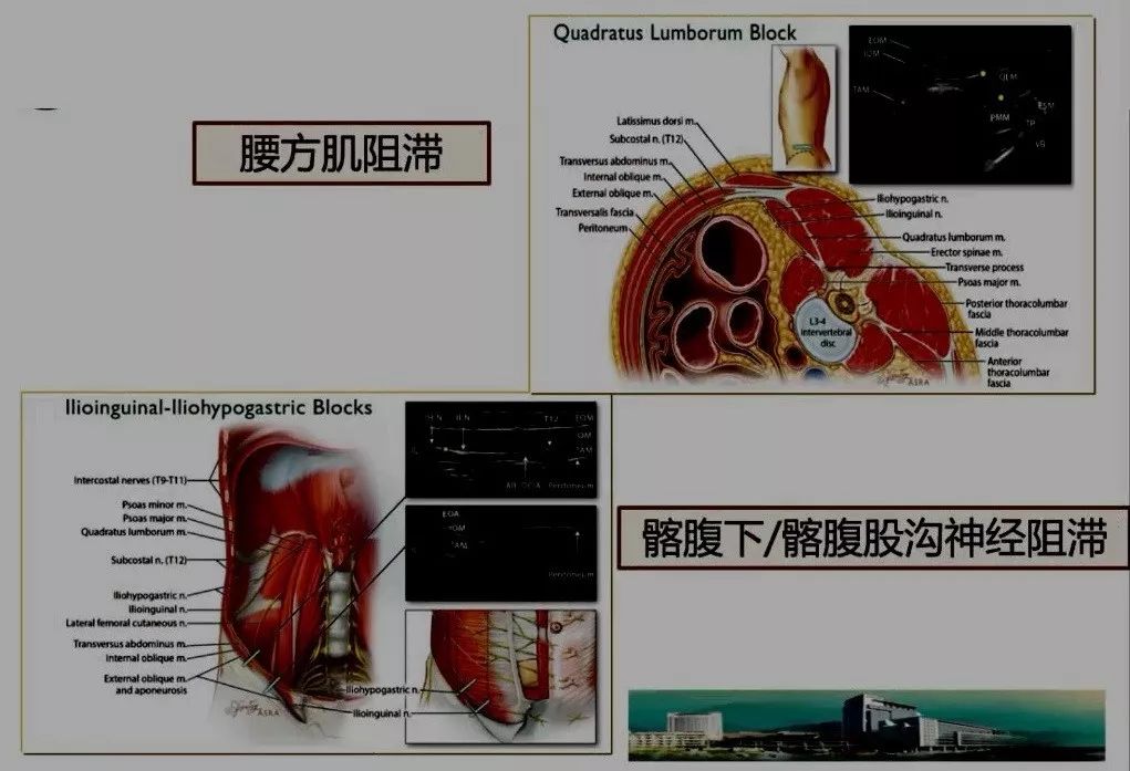 ▼腹部外科手术:胸段硬膜外/椎旁阻滞/tap/腰方肌阻滞 nsaids 阿片