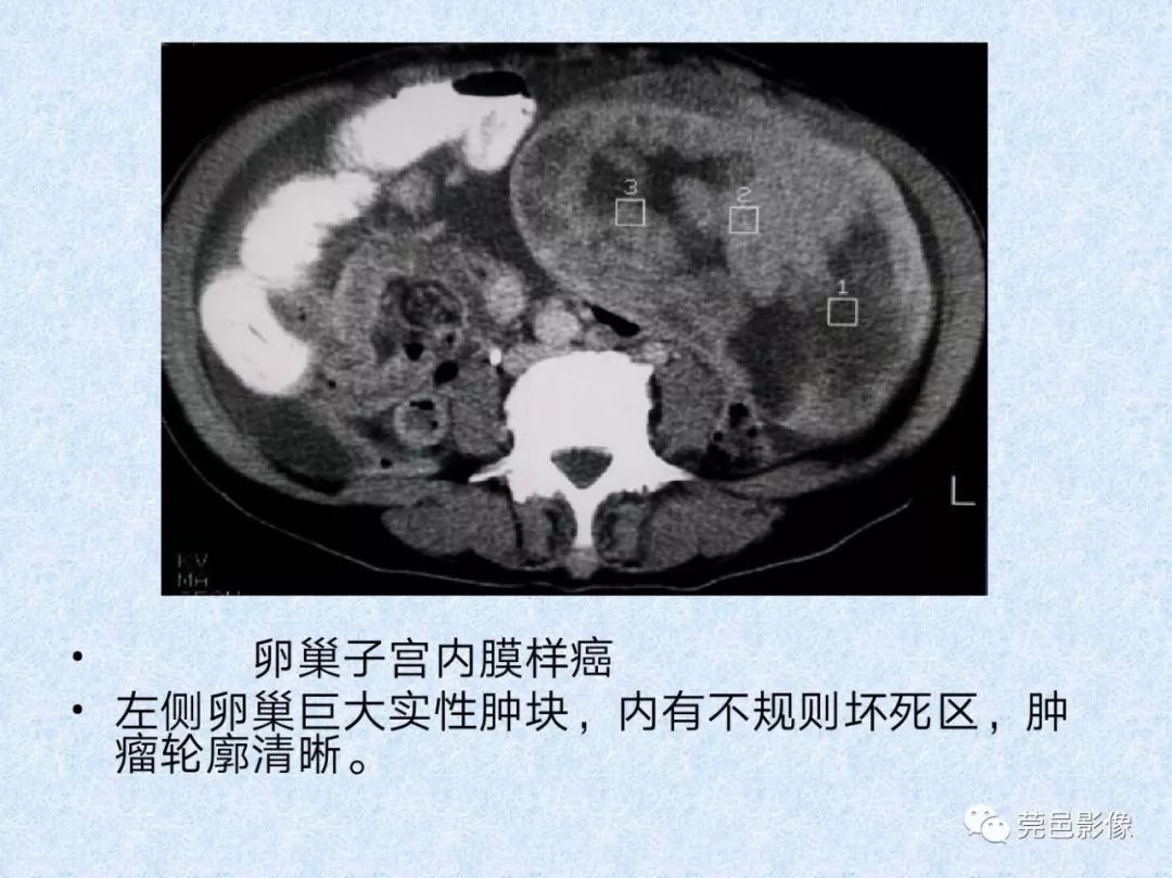 卵巢纤维瘤ct影像表现