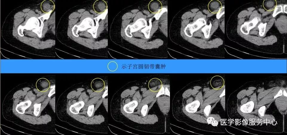 2,形态及大小;长圆形,长径可达子宫圆韧带腹股沟管段全程,横径大小不