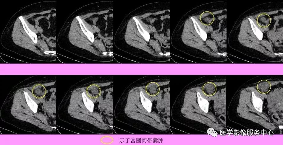 2,形态及大小;长圆形,长径可达子宫圆韧带腹股沟管段全程,横径大小不