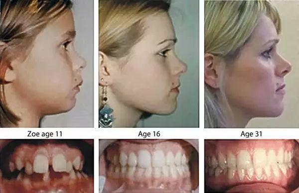 好消息是,如果是牙齿畸形导致的凸嘴,可以通过矫正牙齿改变脸型!