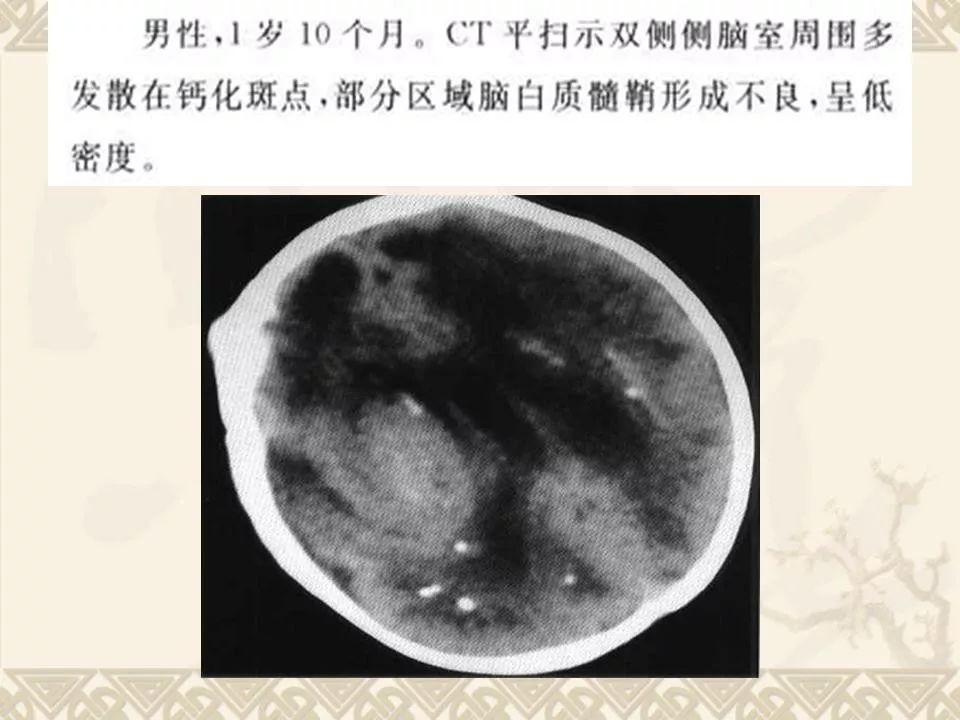 颅内钙化ctmri诊断鉴别诊断