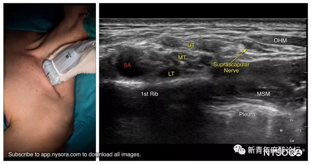 超声引导肩胛上神经和腋神经阻滞(科普)