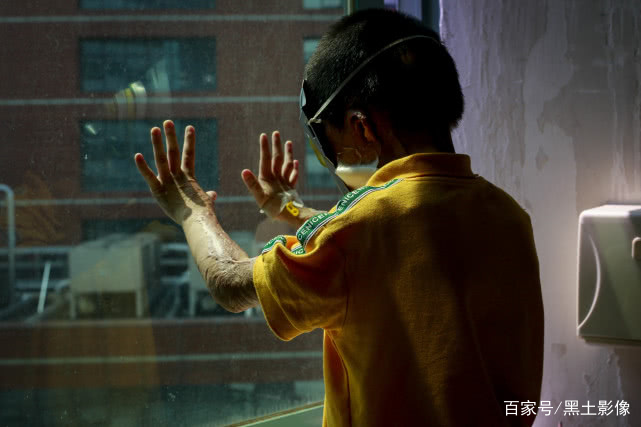 「感情经典语录」原创6岁烧伤男孩被母亲抛弃上幼儿园又被拒，大哭：我很吓人吗？