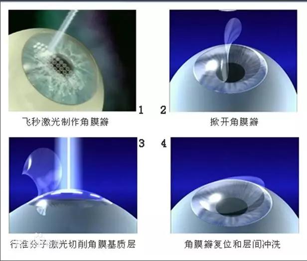 手术治疗近视是什么原理_近视激光手术原理图解