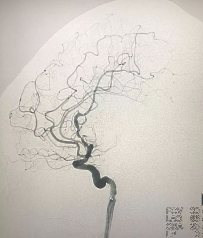 何旭英丨静脉入路栓塞基底节区动静脉畸形(一)