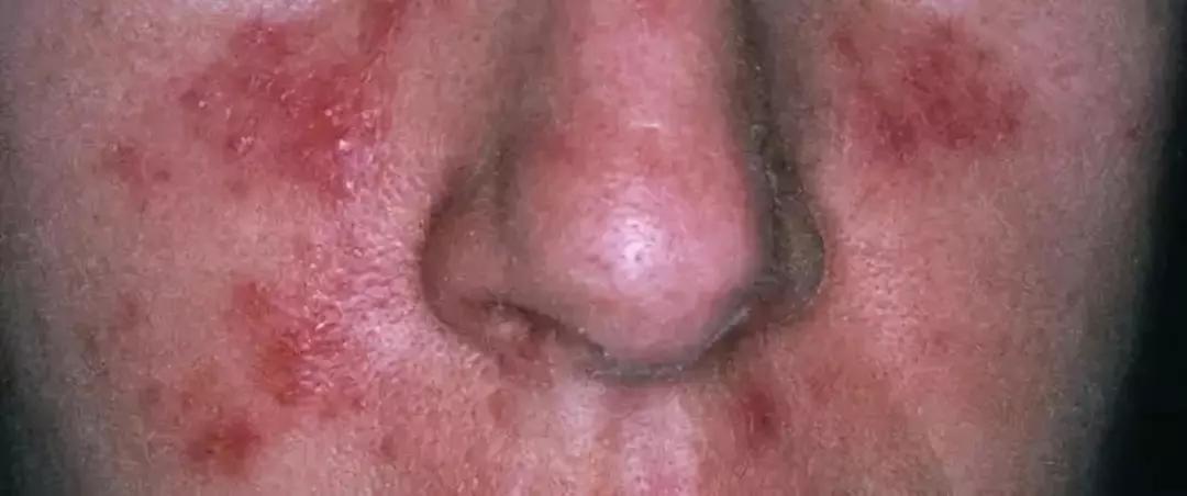 b,丘疹脓包型 c,鼻赘型:皮肤增厚,粗糙(也就是我们常说的酒渣鼻) 目前
