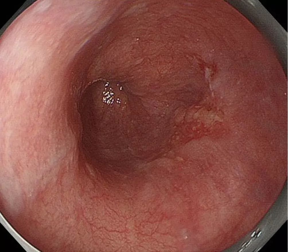 图1 a,食管下段鳞状细胞癌(病理诊断:m)).