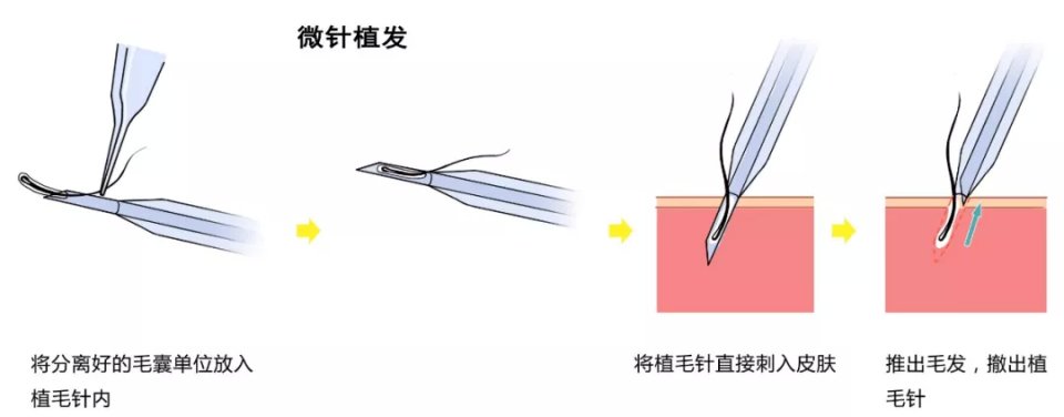 从取出毛囊到种植完成,需在6小时内完成,否则毛囊的存活率将大大