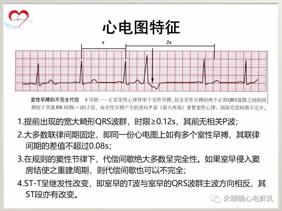 室性早搏的诊断与治疗(ppt)