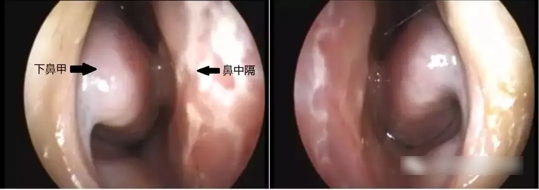 百爪挠鼻的日子又来了,秋季过敏不止是孩子