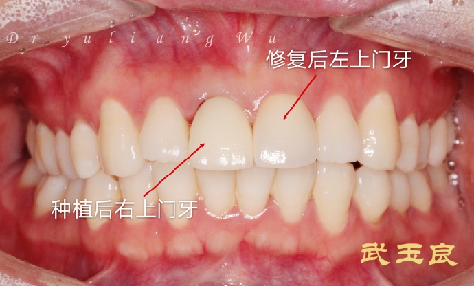 深圳牙齿种植 武玉良医生牙齿种植修复病例