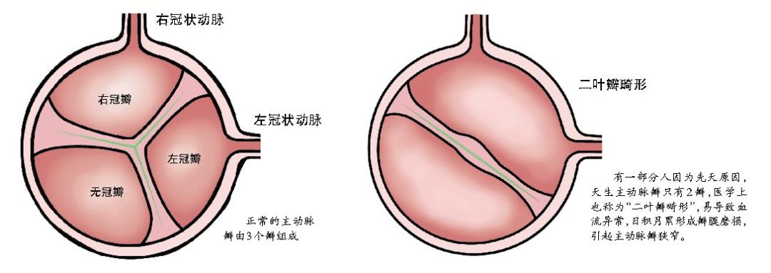 瓣膜(主动脉瓣,肺动脉瓣,二尖瓣,三尖瓣)狭窄或关闭不全等病理改变的