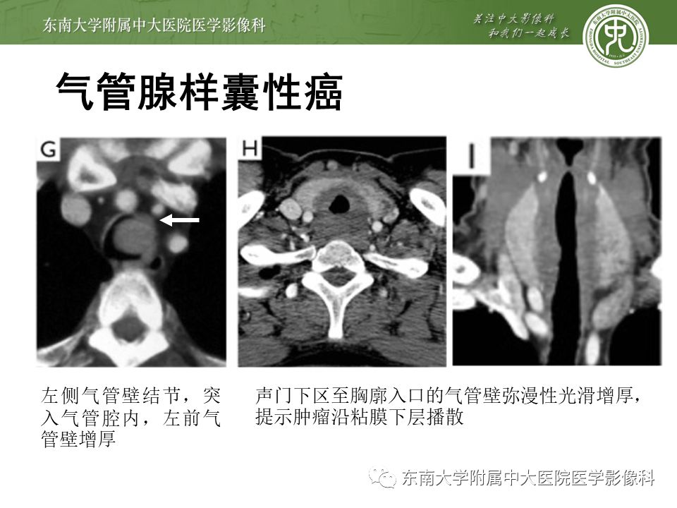 编辑/校对:郑孝飞 病例结果: 气管腺样囊性癌 责任编辑