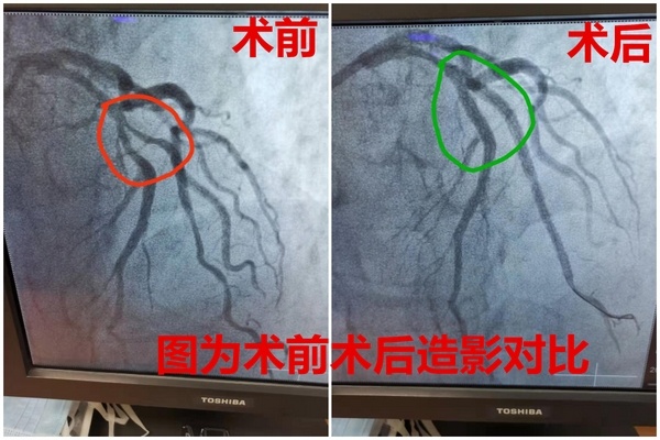 冠脉ct低估病变黑龙江省医院专家冠脉造影找出元凶