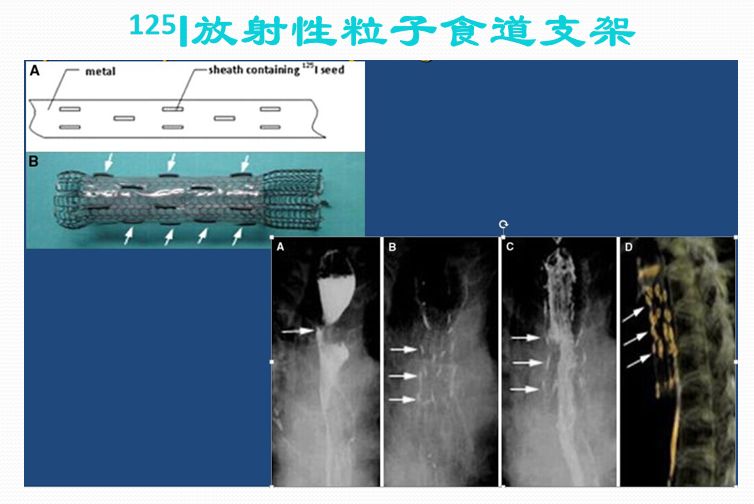 这是我们和中大医院创新性发明的125i放射性粒子食道支架.