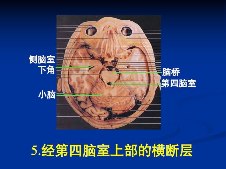 神经解剖| 脑室系统解剖及第三脑室病变常见手术入路