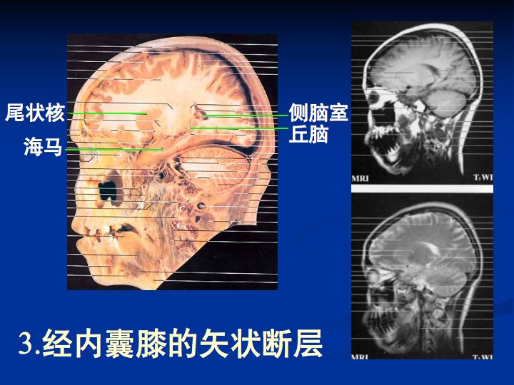 神经解剖| 脑室系统解剖及第三脑室病变常见手术入路