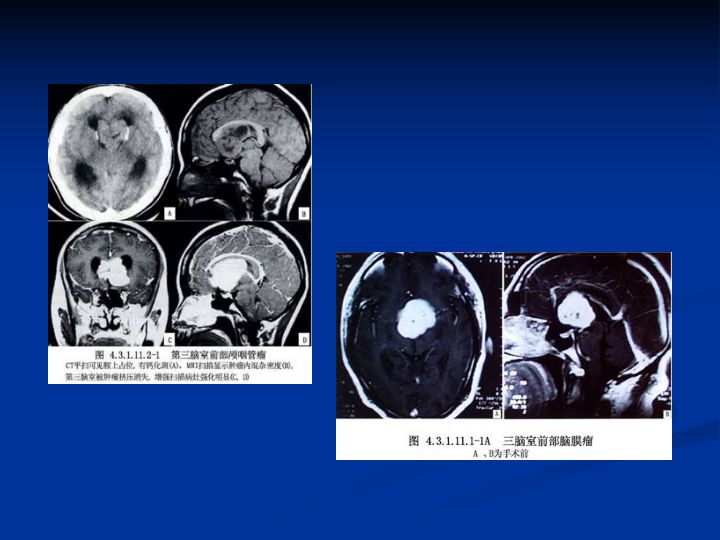 神经解剖脑室系统解剖及第三脑室病变常见手术入路南昌大学一附院徐春