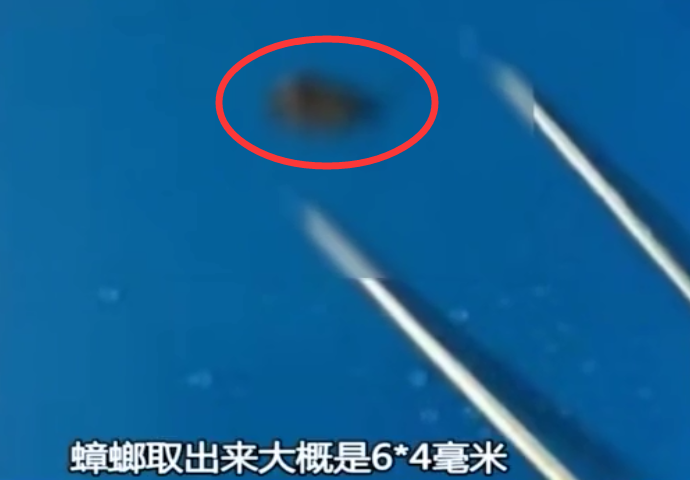 凡凡情感■原创2岁男童哭喊耳朵痛，医生检查发现鼓膜被啃，取出一看家长傻眼！
