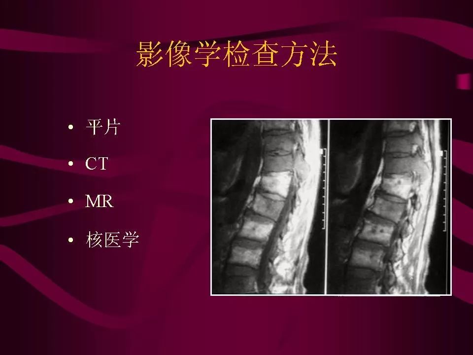 骨转移瘤的影像诊断