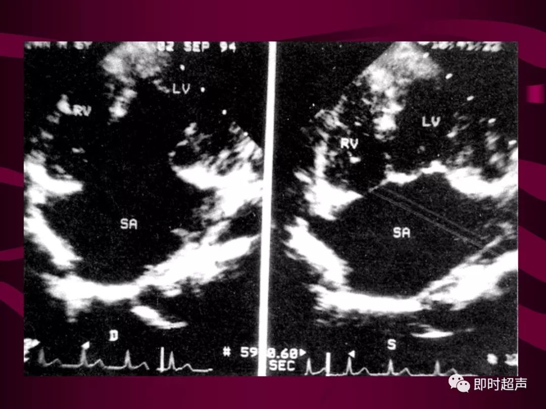 先天性心脏病的超声诊断