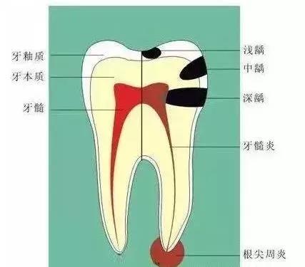 菏泽美维口腔科普牙齿上的小黑点有多可怕你可能还不知道