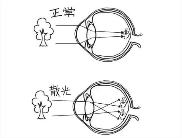 散光眼(astigmatism)