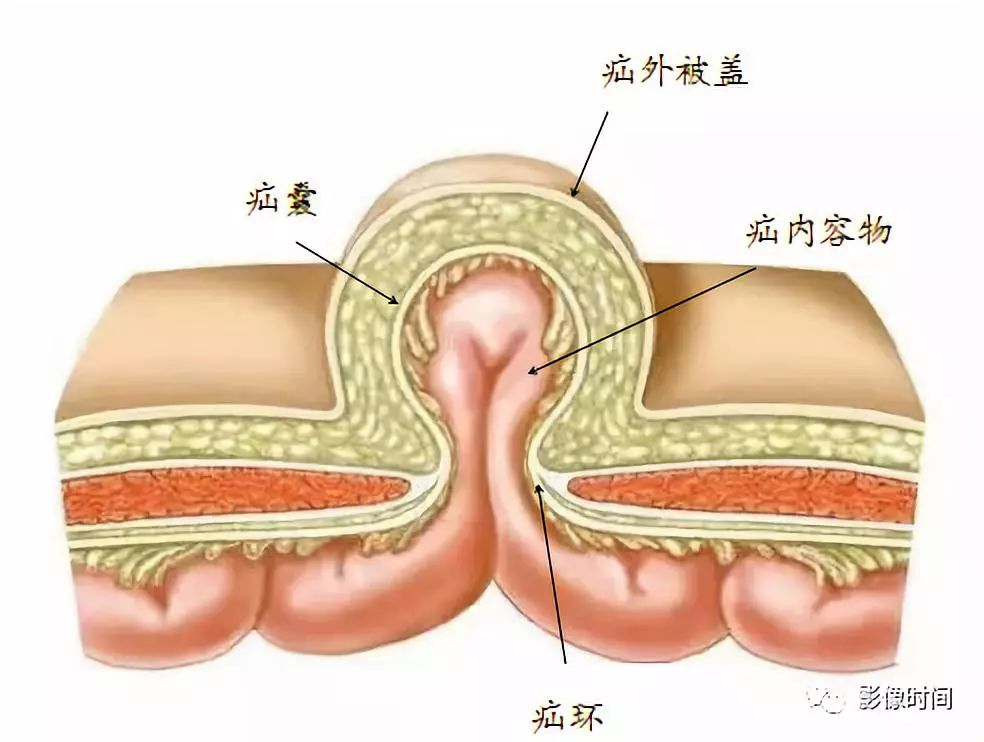 按疝的解剖部位分类