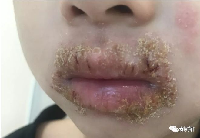 秋天嘴唇又干又肿,喜欢舔.原因并不只是缺水!尤其是