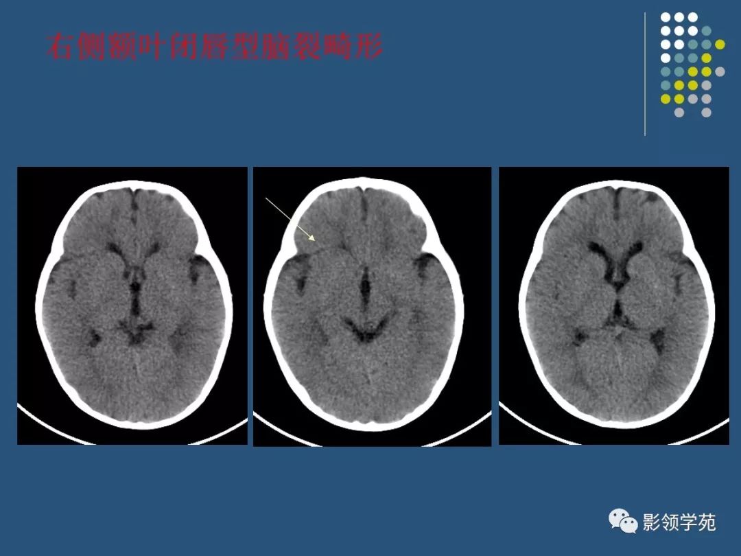 鉴别诊断:开放型脑裂畸形应与脑穿通畸形囊肿鉴别,最关键点是开放型脑