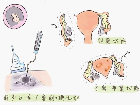 吃什么药可以治疗巧克力囊肿 451acba06e6448dcaac5b96d476a3246.jpeg