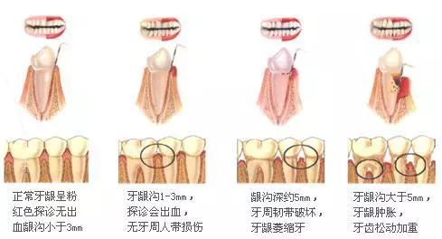 有一颗牙疼怎么办