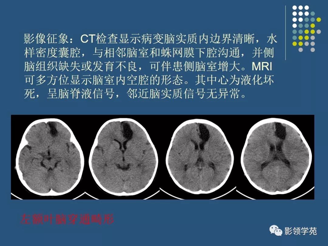 明显占位效应,相邻脑实质有受压改变,脑穿通畸形囊肿占位效应常不明显