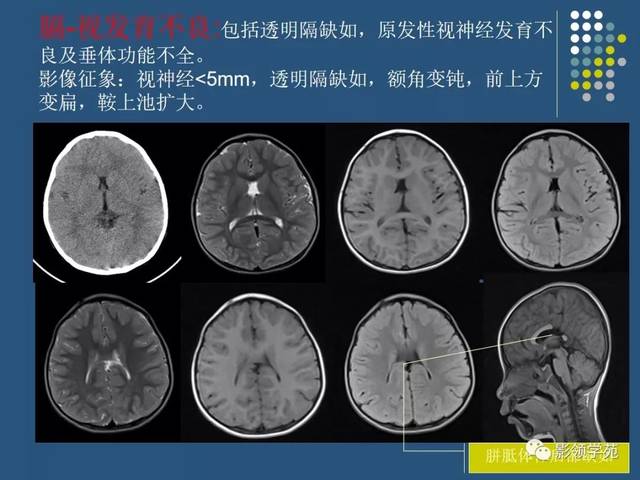 颅脑先天性疾病影像诊断_畸形