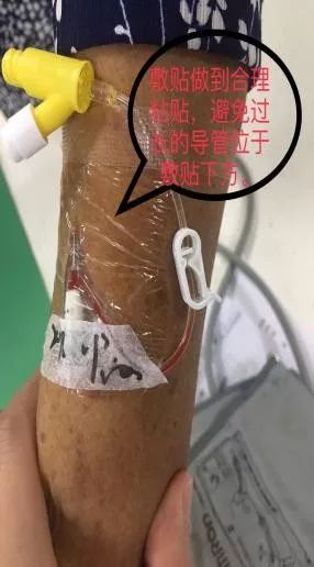 护士,我的留置针怎么又有回血了?