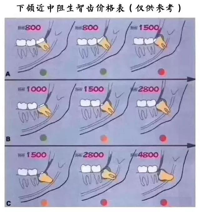 多类型智齿拔除价格参考