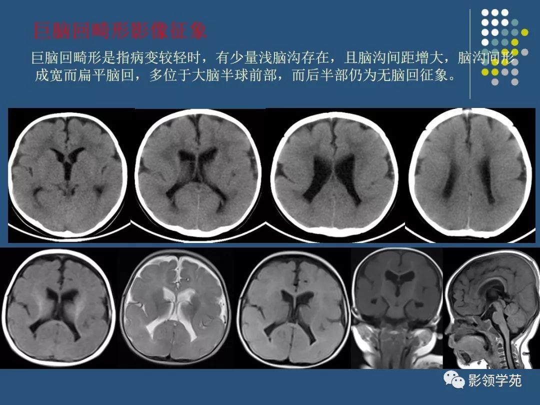 颅脑先天性疾病影像诊断