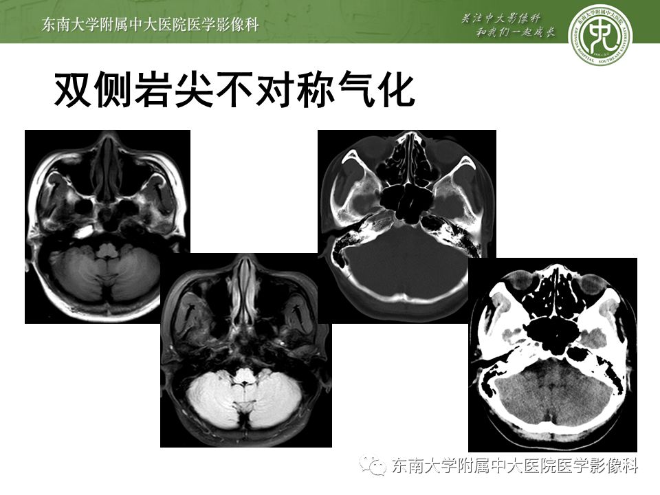 病例结果:颞骨岩尖部病变编辑/校对:郑孝飞平扫mr女,66岁,因"头晕2月