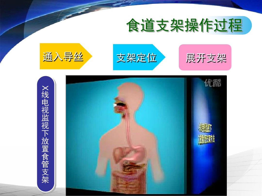 携手合作完成我院首例食管癌支架置入术