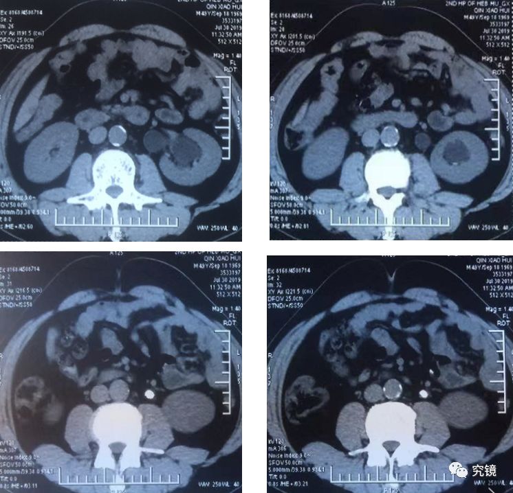 144号作品组合式输尿管软镜治疗输尿管上段结石临床应用分享