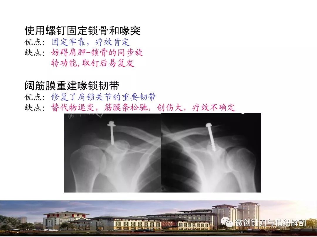 肩锁关节脱位